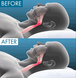 Anti Snoring Mouth Piece